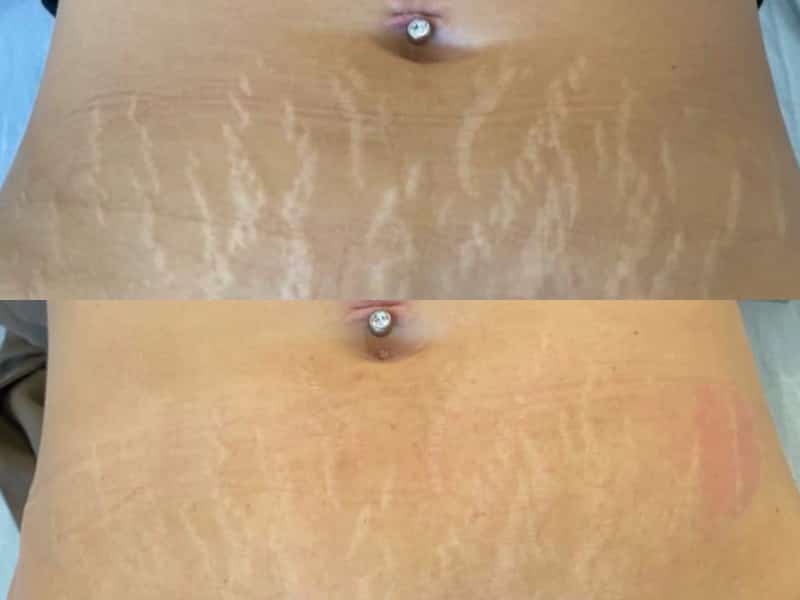 Voor en na een La Fontaine behandeling: striae op de buik